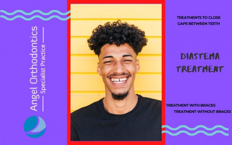 Diastema Treatment - Gap Between Teeth Treatment